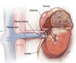 Cancer renal