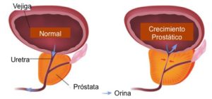 Hiperplasia prostática benigna