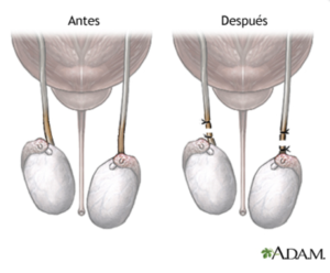 Vasectomía