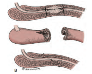 Uretroplastia.