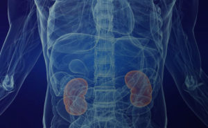 Litiasis Renal (Cálculos Renales)