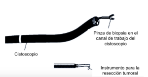 Cistoscopia. Es la visualización directa de la vejiga mediante una cámara en la vejiga