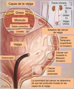 Cáncer de Vejiga