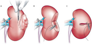 La cirugía preservadora renal