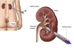 Nefrolitotomía Percutánea